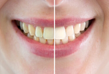 prima-dopo-sbiancamento-dental-smile