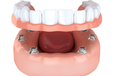 Tooth implantation, denture