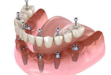 Protesi-dentali-fisse-e-mobili_gallery1