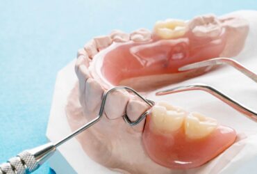 Protesi-dentarie-mobili-Prtoesi-in-Nylon-Padova-dental-clinic