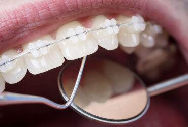 adesivo-ortodonzia-brackets