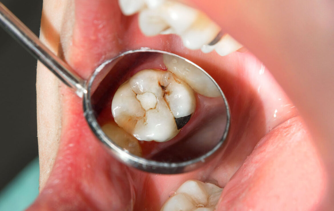Carie dentale, l’approccio più adatto per gestirla al meglio