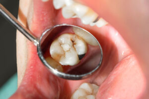 Carie dentale, l’approccio più adatto per gestirla al meglio