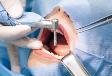 Chirurgia odontoiatrica Brescia