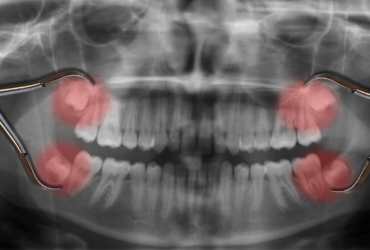 chirurgia-orale-radiografia