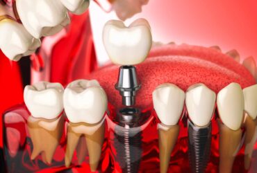 implantologia-dentale (1)