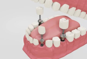 nuove-tecniche-di-implantologia-dentale