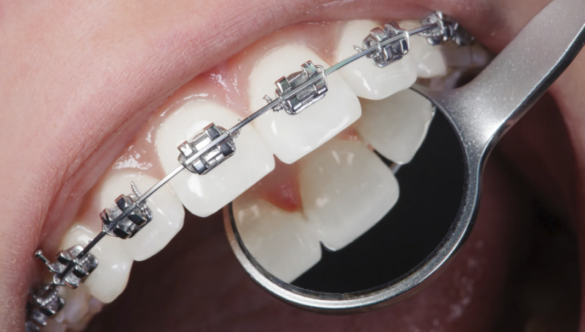 Necrosi della polpa in ortodonzia, il rischio è nei denti traumatizzati