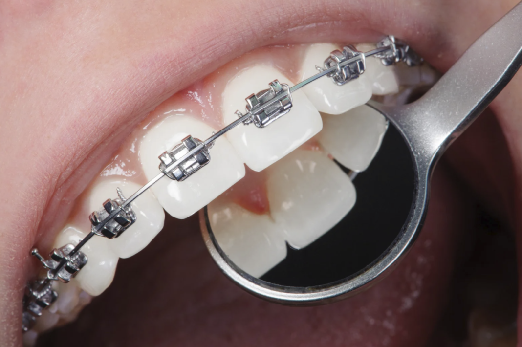 Necrosi della polpa in ortodonzia, il rischio è nei denti traumatizzati