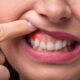 Parodontite: le polveri sottili tra le possibili cause