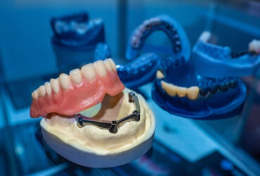 realizzazione-protesi-dentali