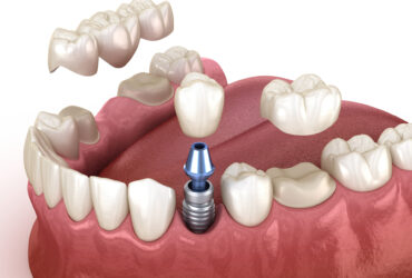 servizi-protesi-dentaria-22-1614783809