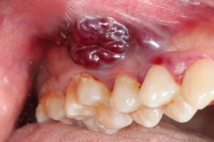 Cancro orale: il ruolo dell’igienista dentale