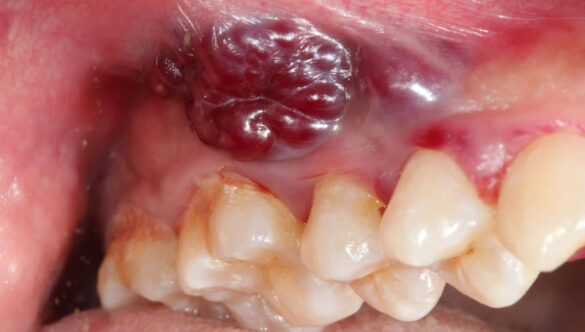 Cancro orale: il ruolo dell’igienista dentale